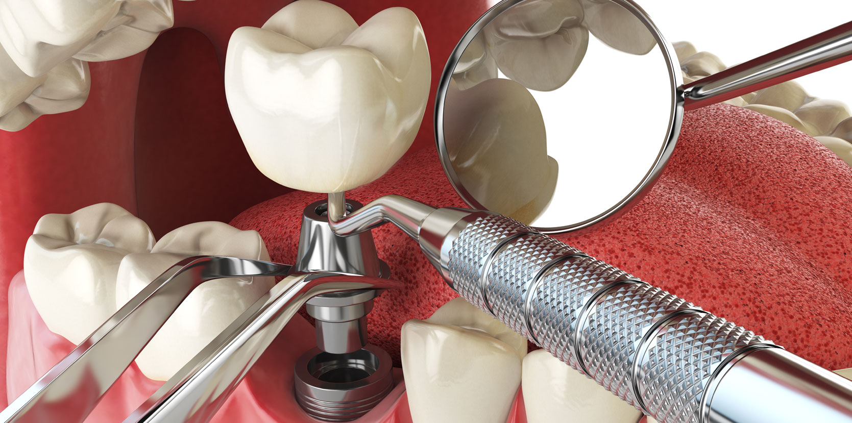 Dental Implants Clifton Park, NY