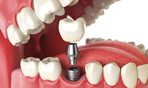 dental implants