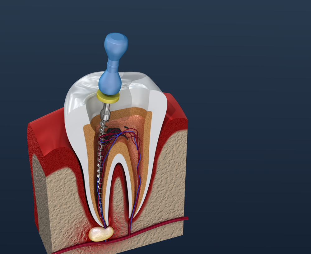 can you travel with root canal