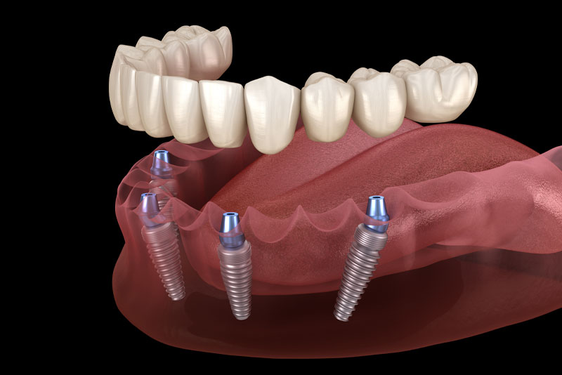 What to Do before Dental Implant Surgery  